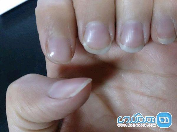 تشخیص سرطان ریه از روی وضعیت ناخن ها تشخیص سرطان ریه از روی شرایط ناخن ها