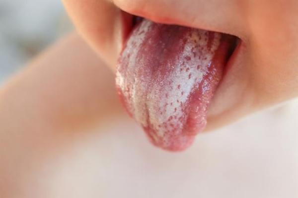 چرا زبانم سفید می گردد؟
